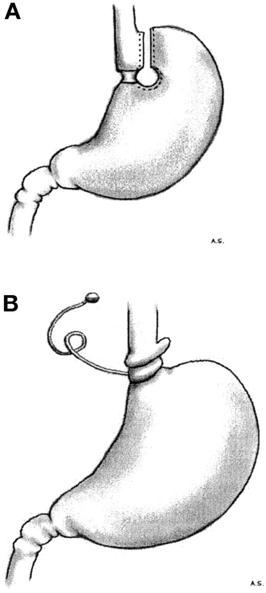 FIG. 1. A: Vertical banded gastroplasty. B: Adjustable gastric banding.