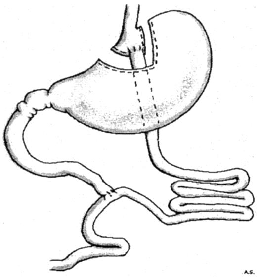 FIG. 2. Gastric bypass.