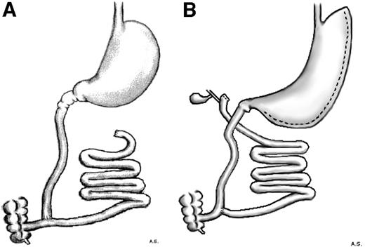 FIG. 3. A: Jejunoileal bypass end-to-side (40 cm to 10 cm). B: BPD with pylorus sparing duodenal switch with 100-cm common channel.