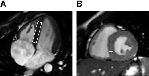 FIG. 1. Myocardial voxel localization for 1H-MRS. Voxel position in four-chamber (A) and short-axis (B) views.