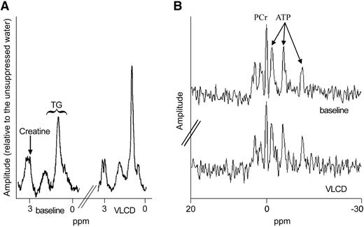FIG. 2. Typical 1H- and 31P-MR spectra at baseline and after dietary intervention. A: 1H-MR spectra at baseline and after a VLCD diet are displayed. Note the increase of the triglyceride signal amplitude at 0.9 and 1.3 ppm after the VLCD without a change in the creatine signal amplitude at 3.0 ppm. B: 31P-MR spectra of one volunteer at baseline and after a VLCD are displayed. Note an unchanged phosphocreatine (PCr) and ATP signal. TG, triglyceride.