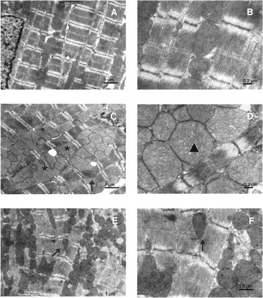 FIG. 2. Electron microscopic images of left ventricle and papillary muscles from control (A and B) and AMPKα2−/− (C–F) mice. A: Overview of a control myocyte in longitudinal section, with mitochondria and myofibrils arranged in regular longitudinal columns. C and E: Longitudinal section of cardiomyocytes from papillary (C) and ventricular (E) muscles from AMPKα2−/− mice showing myofibrillar disorganization and irregular arrangement of intermyofibrillar mitochondria with clusters of mitochondria of variable size. B: Detail of sarcomeres in a control myocyte, showing mitochondria tightly packed along sarcomeres. D and F: Details of sarcomeres in AMPKα2−/− myocytes from papillary (D) and ventricular (F) muscles, showing dense packing of mitochondria of irregular size. Asterisk, large mitochondria having irregular shape. Arrows, splitting of myofibrils. Arrowhead, dividing mitochondrion.