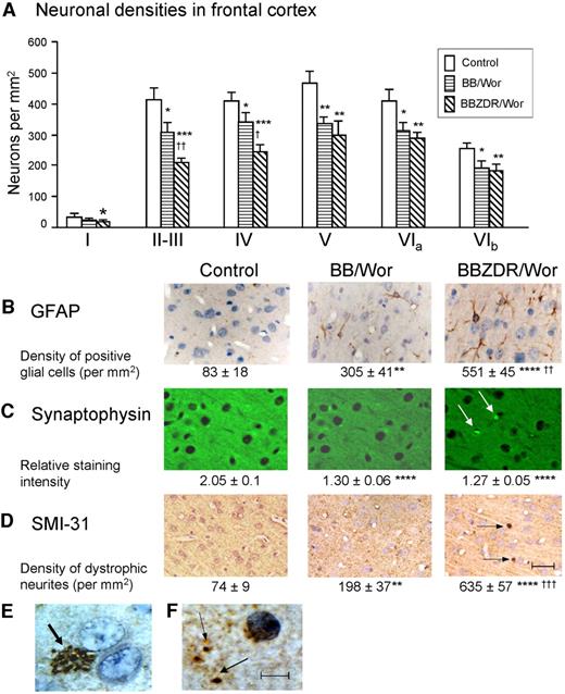 FIG. 1. Quantitative assessment of neuronal densities in frontal cortical layers I–VIb (A). Both type 1 BB/Wor and type 2 BBZDR/Wor rats showed significantly decreased neuronal densities, being significantly more severe in layers II–III and IV in type 2 diabetic rats. The neuronal loss was accompanied by GFAP-positive astrogliosis in layers II–III (B) and a lesser density of synaptophysin-positive staining in the neuropil in diabetic rats. In type 2 diabetic rats, enlarged synapses were occasionally demonstrated (arrows in C). Immunostaining for phosphorylated filaments (SMI-31) demonstrated occasional dystrophic neurites in type 2 diabetic rats (arrows in D). These occurred occasionally as clusters of expanded neurites (thick arrow in E) or as single expanded neurites (thin arrows in F). The densities of SMI-31–positive neurites were increased in diabetic rats. All micrographs are from layers II–III. The bar in Fig. 1D corresponds 50 μm and is representative of Fig. 1B–D. The bar in Fig. 1F corresponds to 12.5 μ and is the same for Fig. 1E. *P < 0.05, **P < 0.01, ***P < 0.005, ****P < 0.001 vs. control rats; †P < 0.01, ††P < 0.005, †††P < 0.001 vs. BB/Wor rats.