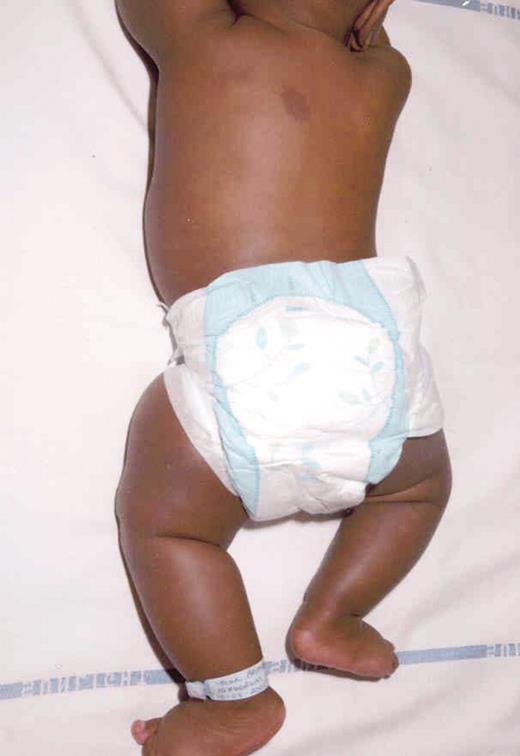 FIG. 1. Photograph of proband showing hemihypertrophy of left leg.