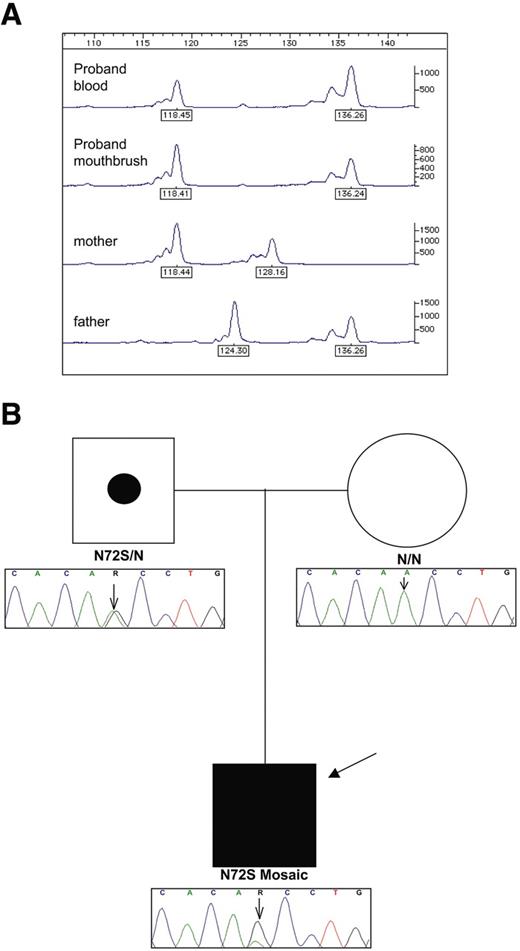 FIG. 2. Results of microsatellite analysis and ABCC8 sequencing. A: Analysis of microsatellite D11S1318 (2.29 Mb from pter, i.e., within the BWS locus). x-axis indicates product size (base pairs); y-axis indicates product quantity (arbitrary units). Note the smaller peak for the maternal allele in the proband's blood sample compared with the buccal sample. B: Pedigree showing mutation status and sequencing electropherograms. The solid symbol indicates the affected proband, and the father is shown as an unaffected carrier of the mutation (dot within an unfilled symbol). The mutated base is indicated by an arrow on the electropherograms.