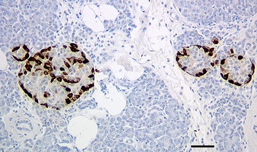 FIG. 1. Nonrandom distribution of glucagons-positive cells in human islets. In normal adult human pancreas, there is a nonrandom distribution of glucagon cells (brown) similar to that seen in rodents. In some small islets, glucagon cells form a mantle around a core of β-cells while larger islets seemed composed of irregular subunits of mantle-core organization. Immunoperoxidase staining for glucagon (brown); hematoxylin. Magnification bar = 50 um. (Please see http://dx.doi.org/10.2337/db07-1842 for a high-quality digital representation of this figure.)