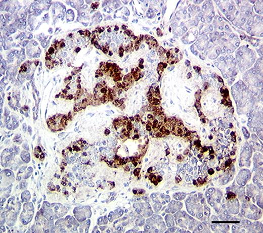 FIG. 2. Amyloid deposits along the islet capillaries. In islets with severe amyloid deposits such as this one, there is a loss of insulin-positive (brown) β-cells and a distorted islet structure. Immunoperoxidase staining for insulin (brown); hematoxylin. Magnification bar = 25 um. (Please see http://dx.doi.org/10.2337/db07-1842 for a high-quality digital representation of this figure.)
