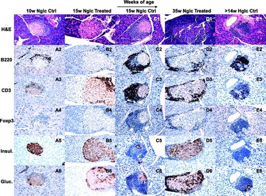 FIG. 3. Histology of prevention studies. At baseline, NOD mice showed mild perinsulitis (A1) with many B220+ cells (A2) and some CD3+ cells (A3) but still with well-preserved insulin and glucagon staining (A5 and A6). FoxP3+ cells are merely present at baseline (A4). Interestingly, at 15 weeks of age, treated NOD mice showed reduced infiltrate (B1) with no B220+ cells (B2) and fewer CD3+ cells (B3), whereas in the control, B220+ and CD3+ cells are abundantly represented with increased infiltrate (C1–C3). At 35 weeks of age, the treated group showed cleaner pancreata compared with the untreated control hyperglycemic NOD mice (D1 and E1). B220+ and CD3+ cells did not infiltrate the islets in the treated group (D2 and D3), whereas in the controls, islets were extensively infiltrated by B220+ and CD3+ cells (E2 and E3). Islet morphology is well-preserved in the treated group at 15 and 35 weeks of age (B5, B6, D5, and D6) but not in the control group (C5, C6, E5, and E6). FoxP3 staining of islet infiltrate revealed a persistent reduced expression of FoxP3 in untreated compared with treated NOD mice at 15 and 35 weeks of age, particularly when compared with the massive presence of T-cells in the control (B4, D4, C4, and E4). (Please see http://dx.doi.org/10.2337/db08-0420 for a high-quality digital representation of this image.)