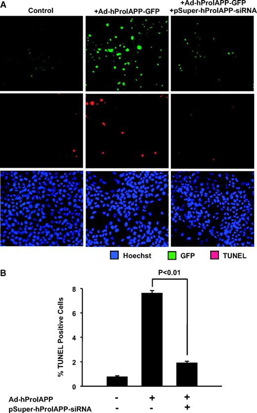FIG. 1. Inhibition of adenoviral-mediated expression of human proIAPP in COS-1 cells by siRNA enhances cell survival. A: COS-1 cells were transduced with Ad-hProIAPP-EGFP (MOI 5; 2 h), incubated with fresh media (4 h) to allow recovery, and transfected with pSuper-hProIAPP-siRNA (4 μg; 4 h). Apoptotic cells were detected 96 h after transfection by double TUNEL (red) and Hoechst-33342 (blue) staining performed on nontransduced control cells (left), cells transduced with Ad-hProIAPP-EGFP alone (middle), or cells transduced with Ad-hProIAPP-EGFP and transfected with pSuper-hProIAPP-siRNA (right). Transduction efficiency in cells transduced with Ad-hIAPP-EGFP, estimated by the number of COS-1 cells expressing GFP 36 h after transduction, was >70%. Transfection efficiency estimated by the number of COS-1 cells expressing pSuper-siRNA-EGFP was ∼60%. Note the higher number of TUNEL-positive cells in COS-1 cells expressing human proIAPP alone (middle) compared with those expressing human proIAPP in the presence of siRNA (right). B: Quantification of TUNEL-positive COS-1 cells transduced with Ad-hProIAPP-EGFP with or without transfection with pSuper-hProIAPP-siRNA. Data are presented as means ± SE of three independent experiments performed in triplicate (P < 0.01, one-way ANOVA). (Please see http://dx.doi.org/10.2337/db08-0485 for a high-quality digital representation of this figure.)