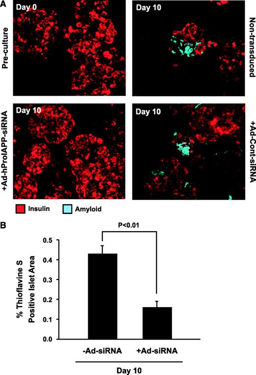 FIG. 3. Suppression of proIAPP expression in human islets inhibits amyloid formation. A: Thioflavine S (light blue) and insulin (red) double staining of paraffin-embedded human islet sections before culture and after 10-day culture with or without transduction with Ad-hProIAPP-siRNA. Amyloid deposits were readily detectable in 10-day-cultured human islets, associated with areas of decreased insulin staining. Amyloid formation was markedly reduced by siRNA-mediated suppression of proIAPP in transduced islets. B: Quantification of amyloid (thioflavine S)-positive islet areas in transduced and nontransduced cultured human islets (day 10). siRNA-mediated inhibition of human proIAPP expression resulted in a 63% decrease in islet amyloid area in transduced islets compared with nontransduced control islets (P < 0.01, Student's t test). (Please see http://dx.doi.org/10.2337/db08-0485 for a high-quality digital representation of this figure.)