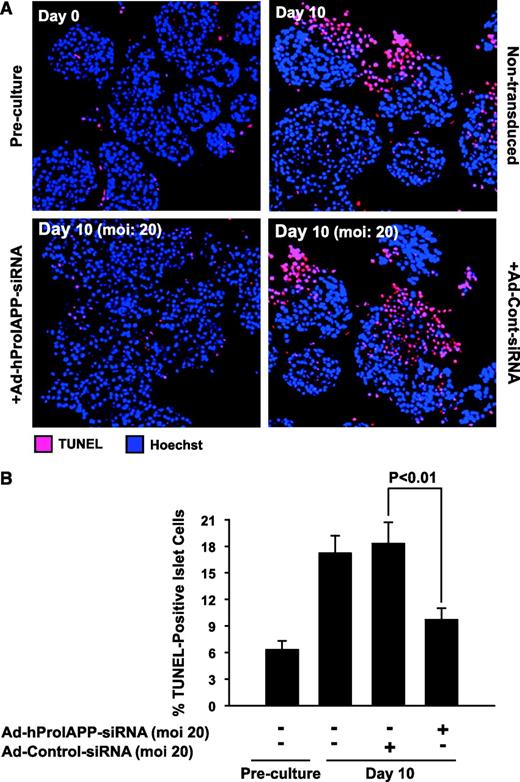 FIG. 4. Prevention of proIAPP synthesis in cultured human islets by siRNA-mediated suppression of proIAPP reduces islet cell apoptosis. A: Paraffin-embedded sections of human islets before culture and after 10-day culture with or without transduction with Ad-hProIAPP-siRNA (or Ad-Cont-siRNA) were stained for TUNEL positivity (red) and Hoechst-33342 (blue). After 10-day culture, extensive TUNEL-positive staining was observed in nontransduced cultured human islets (top right). siRNA-mediated suppression of proIAPP expression markedly reduced the number of TUNEL-positive cells in 10-day-cultured human islets (bottom left). Transduction with Ad-Cont-siRNA did not have any significant effect on the number of TUNEL-positive cells (bottom right). B: Quantification of the number of TUNEL-positive cells as a percentage of the total number of cells in transduced cultured human islets. Results are expressed as means ± SE of three independent experiments (P < 0.01, one-way ANOVA). (Please see http://dx.doi.org/10.2337/db08-0485 for a high-quality digital representation of this figure.)