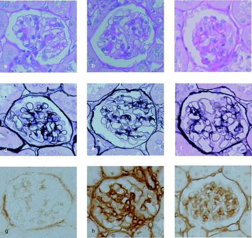 FIG. 2. Glomerular expression of Col4 at 4 weeks after STZ injection. Representative light microscopic appearance of glomeruli (PAS and PASM staining) and immunohistochemistry of Col4 for control rats (a, d, and g), diabetic rats with high urinary Smad1 (b, e, and h), and diabetic rats with low urinary Smad1 (c, f, and i). High urinary Smad1: data from the rats in which urinary Smad1 at 4 weeks was equal or higher than the median. Low urinary Smad1: data from the rats in which urinary Smad1 at 4 weeks was lower than the median. a–c: PAS staining. d–f: PASM staining. g–i: Col4. The original magnification was ×400.