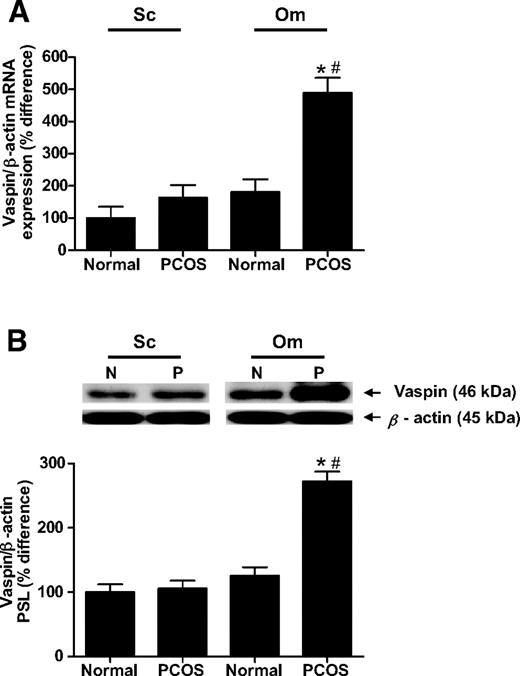 FIG. 1. A: Vaspin mRNA expression relative to β-actin is significantly increased in human omental (Om) and nonsignificantly increased in human subcutaneous (Sc) adipose tissue depots, respectively, when comparing all PCOS women with all normal control subjects, using real-time RT-PCR. Also, vaspin mRNA expression is significantly increased in human omental adipose tissue of all PCOS women when compared with corresponding subcutaneous adipose tissue, using real-time RT-PCR. Data are expressed as % difference to human subcutaneous adipose tissue of all normal control subjects. Group comparison was by Kruskal-Wallis ANOVA and post hoc Dunn's test. *P < 0.05, #P < 0.05. B: Western blot analysis of protein extracts from adipose tissue of all PCOS women and all normal control subjects demonstrate that the antibody against vaspin and the antibody against β-actin recognized bands with apparent molecular weights of 46 and 45 kDa, respectively, in human subcutaneous and omental adipose tissue depots (Fig. 1B). Densitometric analysis of vaspin complexes, having normalized to β-actin, revealed that protein levels of vaspin are significantly increased in human omental and nonsignificantly increased in human subcutaneous adipose tissue depots, respectively, when comparing all PCOS women with all normal control subjects. Also, vaspin protein levels are significantly increased in human omental adipose tissue of all PCOS women compared with corresponding subcutaneous adipose tissue. Data are expressed as % difference to human subcutaneous adipose tissue of all normal control subjects. Group comparison was by Kruskal-Wallis ANOVA and post hoc Dunn's test. *P < 0.05, #P < 0.05. PSL, phospho-stimulated light units.