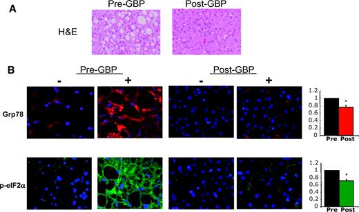 FIG. 6. Liver histology and p-eIF2α and Grp78 immunoreactivity after GBP. Liver tissue sections from patient 67 obtained during and after GBP surgery were stained with H-E or with antibodies against p-eIF2α (green) or Grp78 (red). Nuclei are stained with DAPI (blue). The top panel illustrates severe steatosis in the pre-GBP sample and marked reduction after GBP. Staining is particularly dense around the lipid droplets (black in the stained samples). Quantification of staining is presented as relative intensity of fluorescence in pre- and post-GBP sections. *P < 0.01. (Please see http://dx.doi.org/10.2337/db08-1220 for a high-quality digital representation of this figure.)