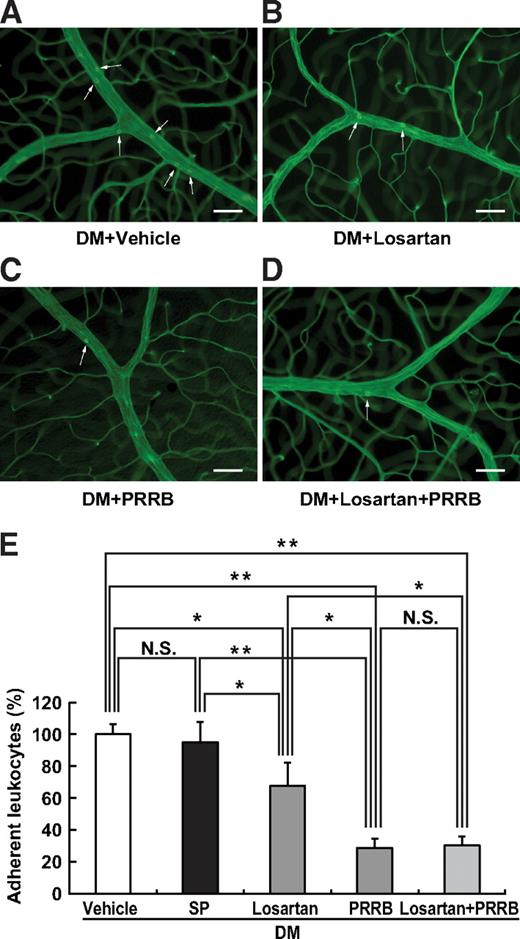 FIG. 4. PRRB was more potent in inhibiting diabetes-induced retinal leukocyte adhesion than the AT1-R blocker losartan. Flat-mounted retinas from diabetic (DM) mice treated with vehicle (A), losartan (B), PRRB (C), or losartan plus PRRB (D). Scale bars: 50 μm. E: Compared with losartan treatment, PRRB application led to significant (P < 0.05) suppression of leukocyte adhesion to the diabetic retinal vessels (n = 10–14). *P < 0.05. **P < 0.01. NS, nonsignificant; SP, scramble peptide. (A high-quality digital representation of this figure is available in the online issue.)