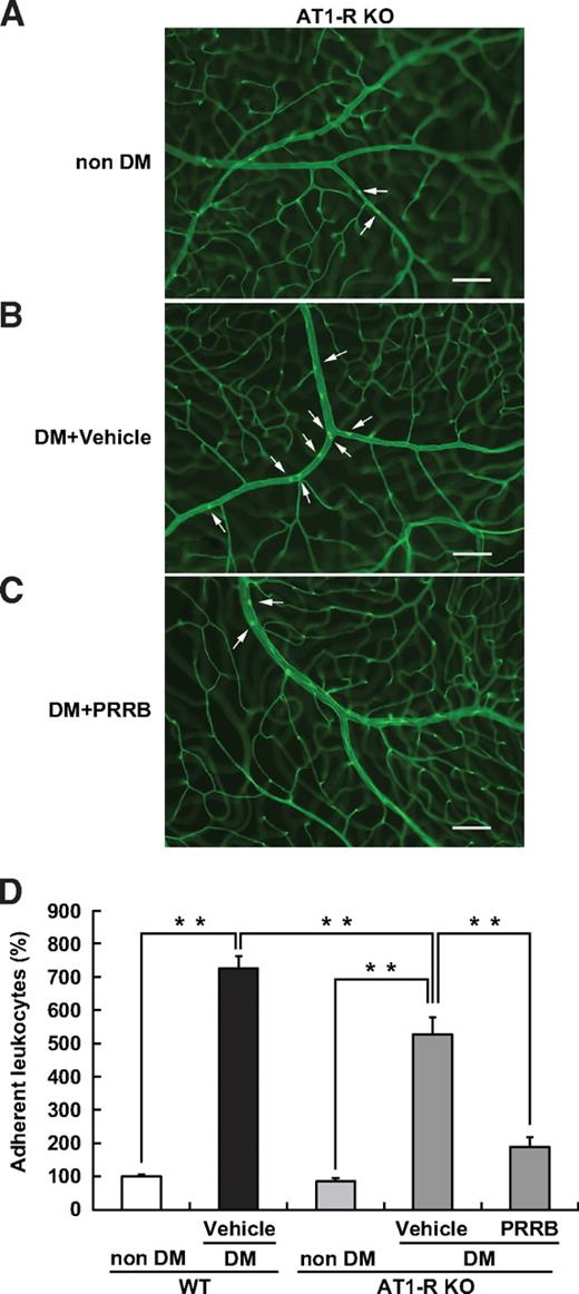 FIG. 5. RAS-independent (pro)renin receptor–mediated intracellular signaling contributes to diabetes-induced retinal leukocyte adhesion. Flat-mounted retinas from nondiabetic (A) and diabetic (DM) AT1-R–deficient mice treated with vehicle (B) or PRRB (C). Scale bars: 100 μm. D: The number of retinal adherent leukocytes. Compared with diabetic wild-type (WT) animals, diabetic AT1-R–deficient mice exhibited a significant reduction of the number of adherent leukocytes. PRRB administration to diabetic AT1-R–deficient mice showed significantly fewer adherent leukocytes than did vehicle administration (n = 6–8). **P < 0.01. KO, knockout. (A high-quality digital representation of this figure is available in the online issue.)