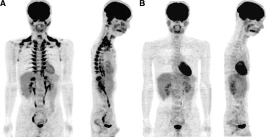 FIG. 1. Whole-body FDG-PET images under cold or warm condition. A: A 25-year-old male subject fasted for 12 h and was kept in an air-conditioned room at 19°C with light clothing and put his legs on an ice block intermittently (for ∼4 min at every 5 min). After 1 h under this cold condition, he was given an intravenous injection of 18F-FDG and kept under the same cold condition. One hour after the 18F-FDG injection, whole-body PET/CT scans were performed in a room at 24°C. B: Two weeks after the first examination in the cold condition (A), the same subject underwent FDG-PET/CT examination as previously, but he was kept at 27°C with standard clothing and without leg icing (warm condition) for 2 h before the examination.