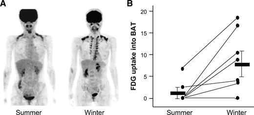 FIG. 2. FDG uptake into BAT in summer and winter. A: A 30-year-old female subject underwent FDG-PET/CT examination under the cold condition as in Fig. 1 on 29 August 2006 (summer) and again on 22 February 2007 (winter). B: Eight subjects (five male and three female subjects) underwent FDG-PET/CT examination under the cold condition in summer (29 August to 28 September 2006) and again in winter (29 January to 6 March 2007). FDG uptake into the supraclavicular region was densitometrically quantified, normalized, and expressed as relative to that in the brain. Thick bars are means ± SD.