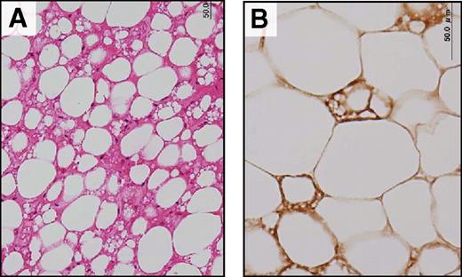 FIG. 4. Histological identification of UCP1-positive brown adipocytes in fat depots obtained from the supraclavicular region. Tissue sections were stained with hematoxylin and eosin (A) or anti-serum against rat UCP1 (B). (A high-quality representation of this figure is available in the online issue.)