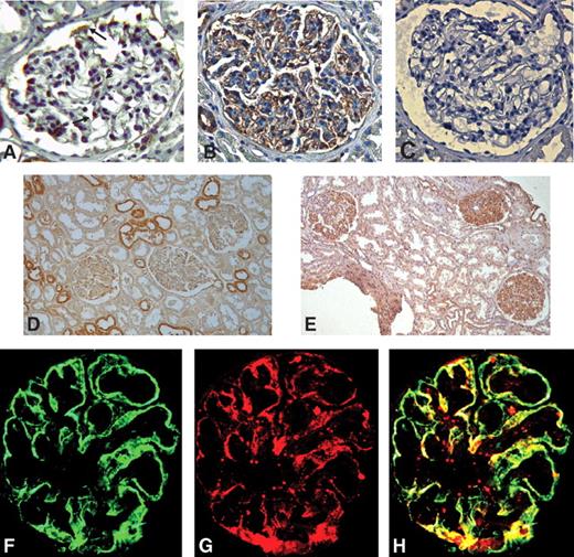 FIG. 4. CCR2 staining of human glomeruli from control subjects and patients with diabetic nephropathy. CCR2 protein expression was evaluated in human glomeruli from control subjects (A and D) and diabetic patients with overt nephropathy (B and E) by immunohistochemistry as described in research design and methods. C: Nonspecific staining was determined by preabsorbing the anti-CCR2 antibody with a 10-fold excess of control peptide. F: Double immunofluorescence for CCR2 (F) and (G) the podocyte marker synaptopodin performed on the diabetic glomeruli showed colocalisation of the positive staining, as demonstrated by merging (H). Magnification ×400 (×80 D and E). Arrows and arrowhead indicate podocytes and mesangial cells, respectively. (A high-quality digital representation of this figure is available in the online issue.)