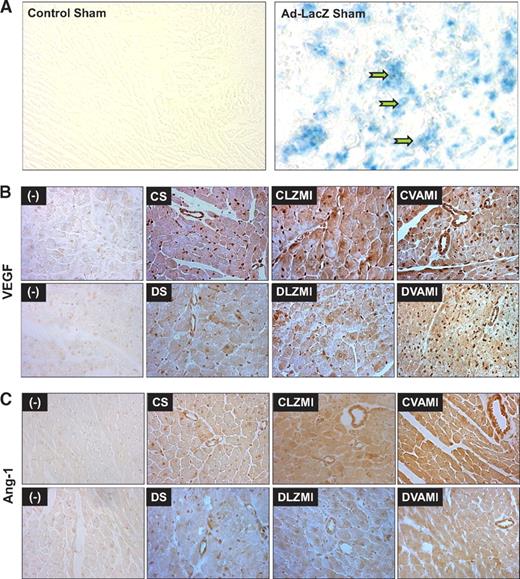 FIG. 1. A: Representative micrographs showing the in vivo transfection efficiency of Ad.LacZ in the nondiabetic sham-operated groups. Robust infection of the myocardium as assessed by β-galactosidase staining in the viable cardiac muscle surrounding the sites of gene transfer can be seen in the Ad.LacZ-transfected myocardium. B: Expression of VEGF as assessed by immunohistochemical staining. C: Expression of Ang-1 as assessed by immunohistochemical staining. The decrease in the expression of VEGF and Ang-1 is evident in the diabetic DS and DLZMI groups compared with the respective nondiabetic CS and CLZMI groups. Increase in the expression of VEGF and Ang-1 can be seen in the groups that received the combination gene therapy (CVAMI and DVAMI) compared with their respective (CLZMI and DLZMI) Ad.LacZ-treated groups. (−) represents representative micrographs showing the sections in which primary antibody was not added to verify the specificity of the staining protocol. CS, nondiabetic control sham; DS, diabetic sham; CLZMI, nondiabetic control animals that received Ad.LacZ injections; DLZMI, diabetic animals that received Ad.LacZ injections; CVAMI, nondiabetic control animals that received combination gene therapy; and DVAMI, diabetic animals that received combination gene therapy. (A high-quality color digital representation of this figure is available in the online issue.)