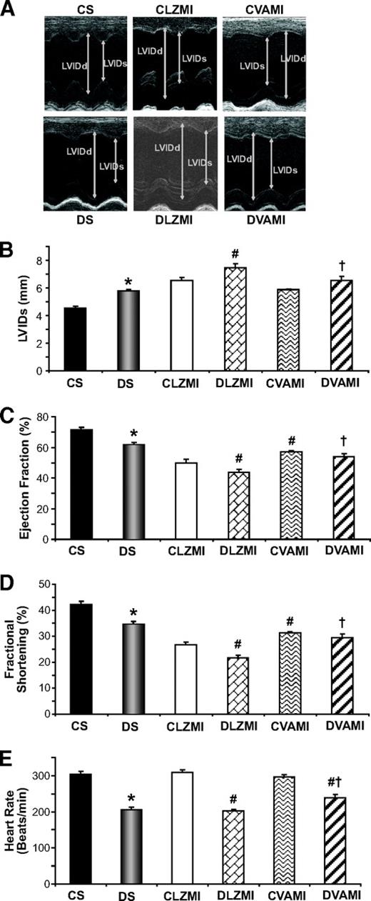 FIG. 6. Effect of combination gene therapy on left ventricular myocardial functions (echocardiography). A: Representative echocardiograph pictures of parasternal short axis images after 30 days of surgery and therapy. Bar graphs represent LVIDs in systole (in mm) (B), % ejection fraction (C), % fractional shortening (D), and heart rate in beats/min (E). There was a significant increase in the myocardial functions in the CVAMI and DVAMI groups compared with the CLZMI and DLZMI groups, respectively. CS (black solid bars), nondiabetic control sham; DS (gray solid bars), diabetic sham; CLZMI (white bar), nondiabetic control animals that received Ad.LacZ injections; DLZMI (diagonal brick bar), diabetic animals that received Ad.LacZ injections; CVAMI (wave bar), nondiabetic control animals that received combination gene therapy; and DVAMI (wide upward diagonal bar), diabetic animals that received combination gene therapy. Values given as mean ± SEM. *P ≤ 0.05 when DS is compared with CS, #P ≤ 0.05 compared with CLZMI, †P ≤ 0.05 when DVAMI is compared with DLZMI.