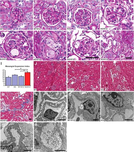 FIG. 1. Renal histopathology in diabetic FXR KO mice. A–I: Representative PAS staining of kidney sections: nondiabetic wild-type C57BL/6, WT (A); diabetic wild-type C57BL/6, WT/STZ (B); nondiabetic FXR KO, KO (C); diabetic FXR KO, KO/STZ (D–H). A–G: Glomerular histopathology. Diabetic FXR KO mice exhibited patent foam cell accumulation (D–G) with dilated capillaries (E) or ballooning of capillaries (F and G). H: Tubulointerstitial injury shown by dilated tubules with flattened epithelium and lipid droplets. I: Mesangial expansion index defined by the ratio of mesangial area/glomerular tuft area. The mesangial area is determined by assessment of PAS-positive and nucleus-free areas in the mesangium excluding glomeruli that accompany mesangiolysis or foam cells. *P < 0.05 as specified (n = 6 mice per group). J–M: Representative Masson's trichrome staining of kidney sections showing the tubulointerstitial fibrosis in diabetic FXR KO mice. N–R: Electron micrographs of glomeruli showing reactive podocyte and endothelial cell (Q) and lytic mesangium (R) in diabetic FXR KO mice. Irregular thickening of GBM in Q indicates possible subepithelial deposit and increased vesicles in the podocyte cell body. Arrows in Q show effacement of podocyte foot processes. Lytic leision in R looks like lipid deposits or cholesterol “clefts.” Scale bar: A–G, 50 μm (shown in G); H, 50 μm; J–M, 50 μm (shown in M); N–Q, 2 μm; R, 10 μm. (A high-quality digital representation of this figure is available in the online issue.)