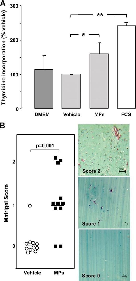 FIG. 5. A: HUVECs proliferation assay (n = 4). 3H-thymidine incorporation with the vehicle (vitreous supernatant) was used as the baseline (100%). Levels of 3H-thymidine incorporation are represented with endothelium cell basal medium (Dulbecco's modified Eagle's medium [DMEM]), FCS (2%), and vitreous microparticles (MPs). Vitreous microparticles (estimated as 65 CD144+ microparticles/μl for the endothelial subpopulation) increased 3H-thymidine incorporation by 1.6-fold compared with vehicle (vitreous supernatant without CD144+ microparticles) (*P = 0.029). FCS (10%) increased it by 2.4-fold (**P = 0.003). B: Matrigel scoring and angiogenesis assay. Serial sections of Matrigel were quantified by two independent pathologists. The presence of capillary structures with massive cells invasion was noticed (2). In some plugs, angiogenesis response was limited to cell invasion (1). Low concentration of vitreous microparticles (10 EMP/μl; 5,000 EMPs added to 500 μl Matrigel) induced endothelial cell migration (score 1; n = 6) and new vessel formation (score 2; n = 3) compared with vitreous supernatant (score 0; n = 12) (P = 0.001). (A high-quality digital representation of this figure is available in the online issue.)