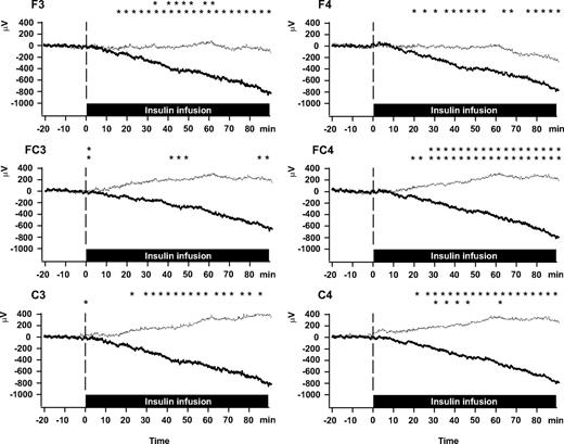 FIG. 2. Average DC potentials recorded from left and right electrodes over frontal (F3, F4, respectively), frontocentral (FC3, FC4), and central (C3, C4) cortical areas before and during intravenous infusion of human insulin (thin lines) and insulin detemir (bold lines), respectively. Infusions started with an insulin bolus injection (human insulin, 17.75 mU/kg body wt; detemir, 90 mU/kg body wt) followed by a steady 90-min infusion (1.0 vs. 2.0 mU · kg−1 · min−1). In both conditions, euglycemia was maintained by infusion of glucose. The average potential during baseline was set to 0 μV. Rows of asterisks indicate significance (P < 0.05; t tests) for point-wise comparisons of the potential levels between conditions (upper row) and between the detemir condition and respective baseline levels (lower row). n = 11.