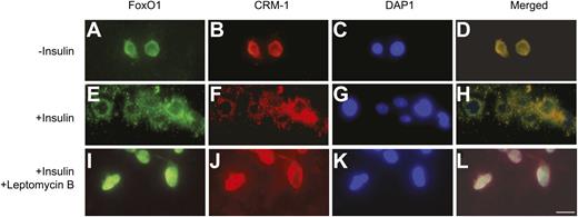 FIG. 5. CRM-1 mediates insulin-dependent FoxO1 trafficking. HepG2 cells were transduced with FoxO1 vector at a fixed dose (50 plaque forming units/cell). After 24-h incubation, cells were serum-starved for 6 h, followed by treatment with insulin (100 nmol/L) in the absence or presence of leptomycin B (10 nmol/L) in culture medium for 30 min, followed by immunohistochemistry using anti-FoxO1 and anti–CRM-1 antibodies. FoxO1 was localized predominantly within the nucleus in the absence of insulin (A–D). In response to insulin, FoxO1 and CRM-1 were translocated from the nucleus to cytoplasm (E–H). This insulin-stimulated FoxO1 trafficking was abolished by leptomycin B (I–L), an agent that binds specifically to CRM-1 and disables the ability of CRM-1 to transport its cargo protein from the nucleus to the cytoplasm. (A high-quality digital representation of this figure is available in the online issue.)
