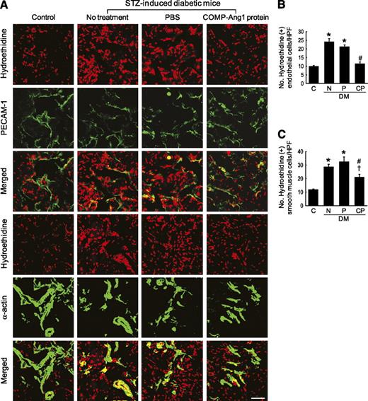 FIG. 4. COMP-Ang1 protein transfer decreases cavernous superoxide anion production. A: In situ detection of superoxide anion in endothelial cells or smooth-muscle cells in age-matched control mice (C), untreated STZ-induced diabetic mice (N), or STZ-induced diabetic mice 2 weeks after receiving intracavernous injections of PBS (P; days −3 and 0; 20 μL) or COMP-Ang1 protein (CP; days −3 and 0; 5.8 μg/20 μL). Corpus cavernosum tissue was incubated with hydroethidine, an oxidative fluorescent dye used to detect superoxide anion, and the antibody to PECAM-1 or with hydroethidine and antibody to smooth-muscle α-actin. Scale bar = 50 μm. B and C: Number of ethidium bromide fluorescence–positive endothelial cells or smooth-muscle cells per high-power field (screen magnification ×400). Each bar depicts the means ± SE from n = 6 animals per group. *P < 0.05 vs. the C and CP groups; #P < 0.05 vs. the N and P groups; †P < 0.05 vs. the C group. DM, diabetes. (A high-quality color representation of this figure is available in the online issue.)