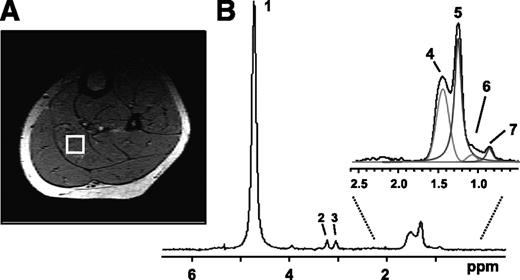 FIG. 3. A localized muscle 1H spectrum acquired from a specific region (voxel) within the soleus muscle. A: The selected voxel is outlined by a white box superimposed on a cross-sectional MRI image of the calf. B: Multiple lipid peaks can be resolved enabling the quantification of IMCL and EMCL. Peak 1: water; peak 2: choline-CH3; peak 3: creatine-CH3; peak 4: EMCL-CH2; peak 5: IMCL-CH2; peak 6: EMCL-CH3; and peak 7: IMCL-CH3.