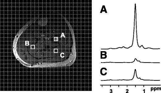 FIG. 7. Magnetic resonance spectroscopic imaging (MRSI) techniques enable the acquisition of spectral data on a point-by-point basis across a region of interest. Muscle 1H-MRSI reveals distinct differences in lipid content between bone marrow (voxel A) and two different locations in the soleus (voxels B and C).