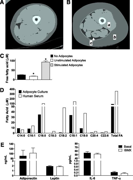 FIG. 1. Adipocyte-myocyte coculture model. Computed tomography images of the thigh comparing (A) a young healthy female subject with (B) an older, obese female subject. a: Thigh muscle; b: subcutaneous adipose tissue; c: intermuscular adipose tissue. C: Free fatty acid concentration of the culture medium after 24-h exposure to basal (unstimulated) or stimulated (+100 μM IBMX) human adipocytes compared with no adipocytes. D: Individual free fatty acids in culture medium exposed to stimulated adipocytes for 24 h compared with no adipocytes. E: Adipokine concentrations in the culture medium after 24-h exposure to basal (unstimulated) or stimulated (+100 μM IBMX) human adipocytes. Results are expressed as mean ± SEM and representative of at least two experiments performed in triplicate. *Significant (P < 0.05) effect of adipocyte exposure analyzed by Student t test. FA, fatty acid. (A high-quality color representation of this figure is available in the online issue.)