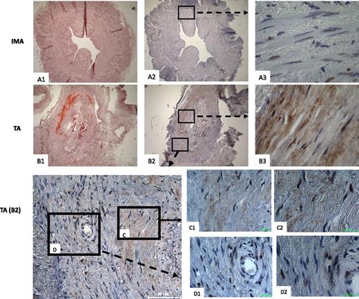 FIG. 1. Representative phase-contrast photomicrographs. Paraformaldehyde-fixed paraffin-embedded sections (7 μm) from control IMA (A1) and diseased tibial artery (TA) (B1) were stained with Alizarin red. A1, A2, B1, and B2 were viewed at magnification ×5; A3 and B3 were viewed at magnification 63; white scale bar in image FA (B2) = 50 μm; green scale bars in C1, C2, D1, and D2 = 10 μm. Calcified areas of FA are colored red, including both medial and intimal calcifications, whereas the IMA control shows a negative stain. Immunohistochemical stain of a contiguous section of the same artery shows upregulated RANKL expression (brown stain) in the vicinity of calcified areas of the tibial artery (B2 and B3) but negative staining of the control IMA (A2 and A3). Within the same TA, calcified areas (C, C1, and C2) showing upregulated RANKL expression are found adjacent to noncalcified areas (D, D1, and D2). (A high-quality digital representation of this figure is available in the online issue.)