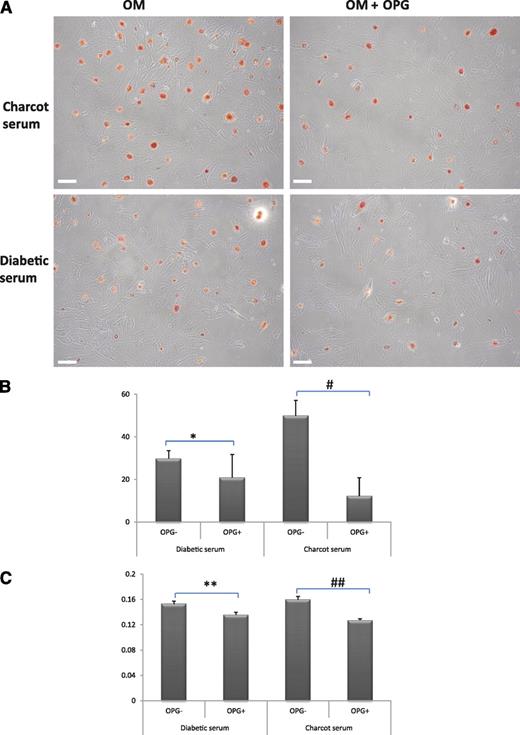 FIG. 5. A: Representative phase-contrast photomicrographs of human VSMCs at day 7 in culture for 7 days. Cells were cultured in OM and Charcot (5%) or diabetic (5%) sera (left) or 20 pmol/L recombinant OPG in addition to the same sera (right). The orange-red spots indicate mineralized nodule formation. White scale bar = 100 μm. B: ALP activity (μmol/L phosphate/mg protein/min) of cells at day 7. The inhibitory effect of OPG on the osteoblastic differentiation of human VSMCs is more marked in Charcot serum (#P = 0.011) compared with diabetic serum (*P = 0.120). C: Extent of mineralization of human VSMCs at day 7. The inhibitory effect of OPG on human VSMC mineralization is markedly significant in Charcot serum (##P = 0.004) but not significant in diabetic serum (**P = 0.249). (A high-quality digital representation of this figure is available in the online issue.)