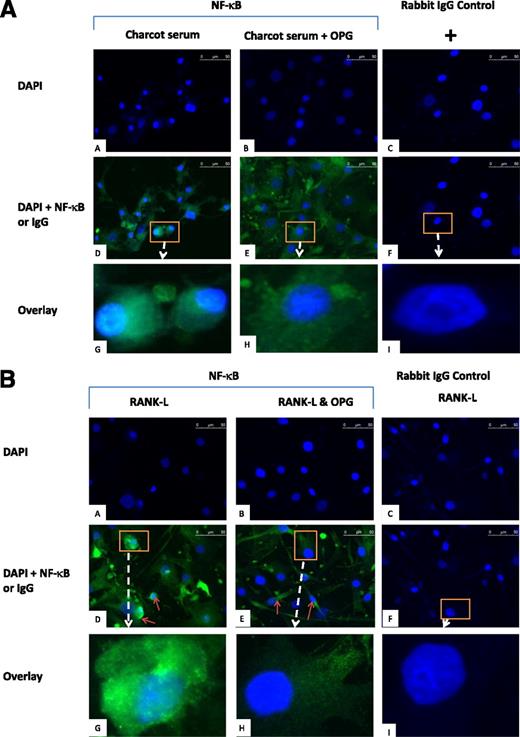 FIG. 6. Fluorescent photomicrographs from immunocytochemical experiments. Human VSMCs were cultured to confluence in growth media and subsequently incubated for 1 h in (A) OM with Charcot serum (5% v/v) or coincubated with Charcot (5% v/v) serum plus 20 pmol/L recombinant OPG and (B) OM, including 20 pmol/L recombinant human RANKL with or without plus 20 pmol/L recombinant human OPG. After 1 h, immunohistochemical staining to localize NF-κB was performed using rabbit anti-human p65 antibody. Goat anti-rabbit secondary antibody conjugated to a fluorescent dye (Alexa-Flour 488) was used to locate NF-κB staining (green) (D and E), whereas DAPI was used to stain the cell nucleus (blue) (A–C). Nonimmune rabbit IgG was used as negative antibody control (C, F, and I). Charcot serum induced nuclear translocation of NF-κB as seen by the intense perinuclear green stain (A, image G). Coincubation with OPG prevented the translocation of NF-κB, which remained predominantly cytoplasmic (A, image H). Likewise, RANKL induced nuclear translocation of NF-κB as seen by the intense perinuclear green stain (B, image G). Coincubation with OPG prevented the translocation of NF-κB, which remained predominantly cytoplasmic (B, image H). (A high-quality digital representation of this figure is available in the online issue.)