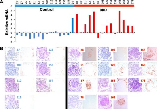 FIG. 4. Increased expression of complement in diabetic glomeruli. A: Relative mRNA level of C3 in individual glomerular samples control (blue bars) and from DKD samples (red bars). B: Representative images of periodic acid-Schiff staining and C3 immunostaining of individual kidney-tissue samples. (A high-quality digital representation of this figure is available in the online issue.)