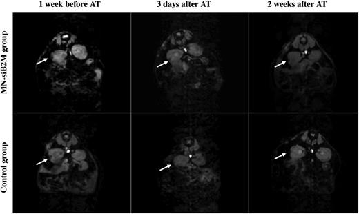 FIG. 3. Representative T2* weighted MR images of grafts labeled with MN-siB2M or control probes under the left kidney capsule of NOD (B2M null)/scid mice 1 week before and 3 days and 2 weeks after adoptive transfer (AT) of T cells (white arrows indicate the islet grafts areas).