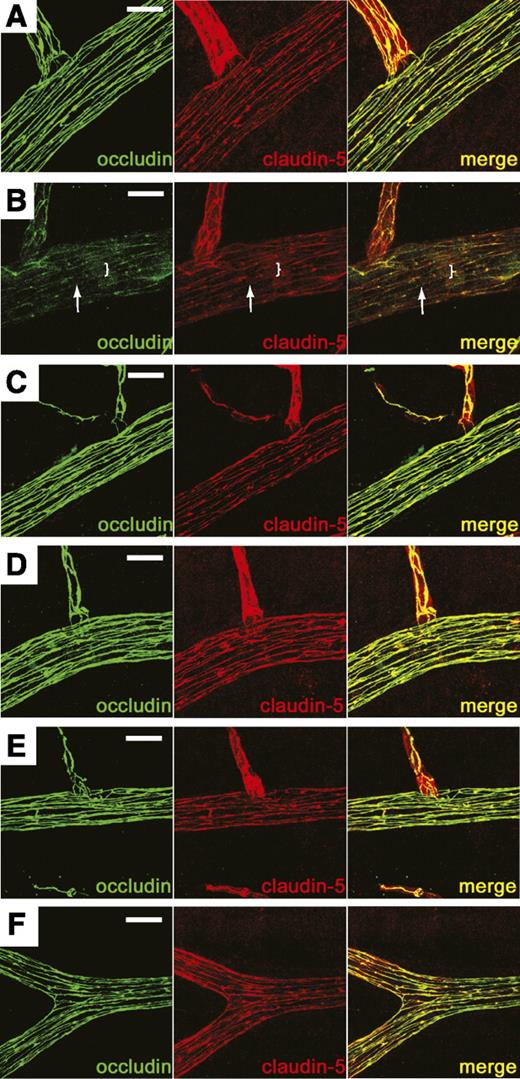 FIG. 5. PKCβ-mediated TJ redistribution in rat retinal arterioles. Retinal whole mount immunostaining for occludin (green) or claudin-5 (red) in control (A), VEGF-treated (B), PKCβI (C), VEGF and PKCβI (D), LY379196 (E), or LY379196 and VEGF (F). VEGF reduced cell border staining (arrow) and increased a diffuse cytoplasmic staining (bracket) of TJ proteins that was prevented by the PKCβ inhibitors. Scale bar = 20 μm. (A high-quality digital representation of this figure is available in the online issue.)