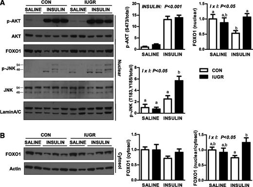 FIG. 5. The effect of growth restriction (IUGR) and hyperinsulinemia (insulin) on nuclear AKT, FOXO1, and JNK in the fetal liver. A: Nuclear protein expression of p-AKT (S473), total AKT, total FOXO1, p-JNK (p54 and p46 at T183/Y185), total JNK (p54 and p46), and lamin A/C measured by Western blotting. B: Cytosolic protein expression of FOXO1 and β-actin. Representative images and quantification of results and ratio of nuclear to cytosolic FOXO1 protein expression are shown. Means ± SE are shown for saline (CON, n = 4; IUGR, n = 4) and insulin (CON, n = 6; IUGR, n = 6). Significant effects from two-way ANOVA are indicated. Bars with different letters are significant differences when interaction (I × I) is significant.