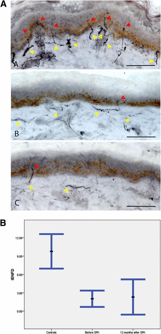 FIG. 1. A: Skin biopsies immunostained for PGP9.5. Healthy control (A) shows numerous intraepidermal nerve fibers (red arrowheads) reaching upper levels of epidermis with a well-developed subepidermal nerve plexus (yellow arrowheads) in a healthy subject (A) compared with scant subepidermal and minimal intraepidermal nerve fibers in the diabetic patient both at baseline (B) and at follow-up (C). Scale bar = 100 µm. B: IENFD in control subjects and in diabetic patients at baseline and 12 months after SPK. Data are mean ± SEM. (A high-quality digital representation of this figure is available in the online issue.)