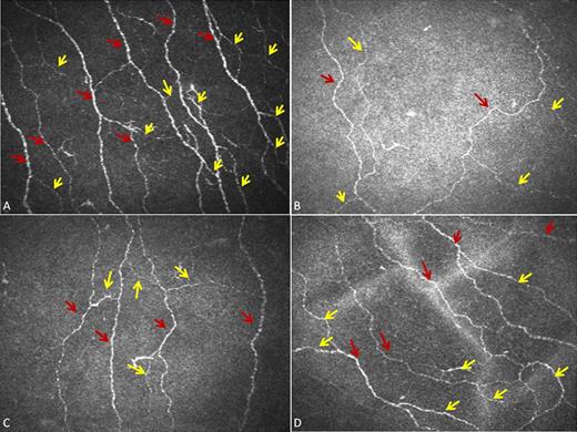 FIG. 2. CCM images from Bowman’s layer of cornea: a control subject (A) and patient with type 1 diabetes at baseline (B) and at 6 (C) and 12 (D) months after SPK. The red arrows indicate main nerve fibers, and yellow arrows indicate branches. (A high-quality color representation of this figure is available in the online issue.)