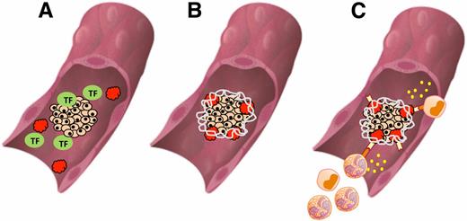 FIG. 3. IBMIR. This inflammatory reaction is elicited by direct contact between islets and blood (9). A: Islets express tissue factor (TF), which activates a thrombotic reaction. B: Thrombin forms fibrin capsules around the islets and activates platelets, which bind to the islets. C: Activated platelets upregulate P-selectin markers resulting in the infiltration of neutrophils and monocytes. Also, thrombin stimulates the activation of granulocytes and monocytes. In addition, platelet-activating factor produced by portal endothelial cells and complement products serve as chemoattractants for more neutrophils and macrophages. Tissue factor, fibrin, and fibrinogen may directly affect macrophages.