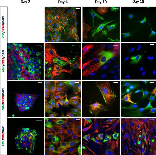 FIG. 2. Dedifferentiation of pancreatic exocrine fractions is accompanied by EMT. Immunocytochemistry of plated pancreatic exocrine fractions was performed from day 2 to day 18 in culture. The pancreatic exocrine markers amylase (AML) and CK19, the epithelial marker E-cadherin (ECAD), and the mesenchymal marker vimentin (VIM) expressions were analyzed on days 2, 4, 10, and 18 of culture. Nuclei were counterstained with DAPI. Scale bar = 20 μm.