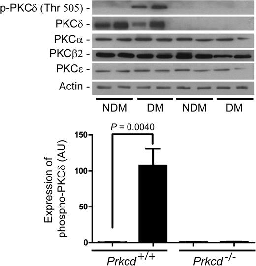 FIG. 5. Increased PKCδ activity in muscles of diabetic mice. Expression of p-PKCδ (Thr 505), PKCα, PKCβ, PKCδ, PKCε, and actin was detected by immunoblot in nondiabetic (NDM) and diabetic (DM) mice (top panel), and densitometric quantitation was measured in NDM (□) and DM (■) mice (bottom panel). Results are shown as mean ± SD of four to six independent experiments.