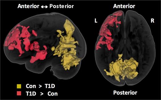 Figure 1. Sagittal (left) and axial (right) three-dimensional renderings of clusters of significant differences between T1D and control subjects. Increased GMV in lateral temporo-frontal regions in T1D relative to control subjects (red cluster, P < 0.01) was also found to be associated with higher HbA1cDX. Decreased GMV in occipital regions and cerebellum in T1D relative to control subjects (yellow cluster, P < 0.001) was found to be associated with higher HbA1cAUC6% and higher mean glucose.