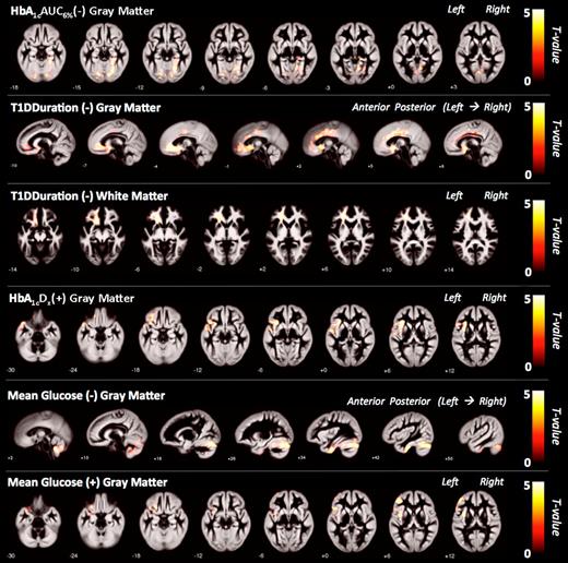Figure 2. Significant GMV clusters from whole-brain regression analysis of glycemic measures in the T1D group (height threshold of T = 1.66, cluster extent threshold of P < 0.05, and corrected for FWE and nonstationary smoothness). Clusters are overlaid on the average GM template. HbA1cAUC6% (−) (P < 0.001), T1D duration (−, GMV) (P = 0.001), T1D duration (−, WMV) (P < 0.001), HbA1cDX (+) (P = 0.01), mean BG (−) (P = 0.007), and mean BG (+) (P = 0.03).