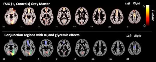 Figure 3. Regions with significant correlations between IQ and GMV. Top: Clusters from whole-brain regression analysis of IQ in the control group (height threshold of T = 1.66, cluster extent threshold of P < 0.05, and corrected for FWE and nonstationary smoothness). Bottom: Conjunction regions with IQ-GMV correlations in control subjects and glycemic-GMV correlations in T1D. Color denotes glycemic variable/contrast: T1D duration (−) (blue), mean glucose (−) (green), control >T1D (red), overlap (yellow). Clusters are overlaid on the average GM template.