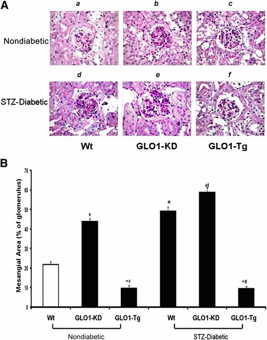 Figure 3. Quantitation of mesangial fractional volume (n = 15). A: Representative photomicrographs of PAS-stained glomeruli from kidneys of nondiabetic and diabetic Wt (a,d), GLO1-KD (b,e), and GLO1-Tg (c,f) mice. Original magnification ×600. B: Quantitation of mesangial fractional volume for each group of mice. Data are expressed as mean ± SD (*P < 0.05 vs. Wt; #P < 0.05 vs. STZ-Wt; ANOVA).